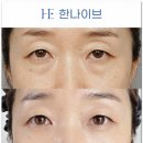 유스외과의원 | 눈밑지방재배치 가격 현명하게 비교하려면