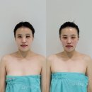 고운프라자 | 고운빛깔에스테틱 김해장유점 웨딩관리 후기｜온다웨이브 효과 실화