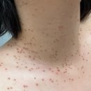현재 | 얼굴 편평사마귀 편사 제거 후 관리 | 4일차~10일차(현재) 후기