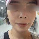 해율한의원 - 마포구 양화로 166 | 홍대 여드름흉터관리 2회차, 해율한의원 꾸준히 다니는 후기 (다음은 약초침!)