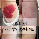 [치료 1년차] 아기 딸기 혈관종 치료 추적관찰 (마지막)