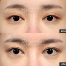 시선성형외과의원 | [시선성형외과 돌출눈성형] 토안, 겹주름 개선후기 (밑트임을 병행해도 토안 개선이 가능할까?)