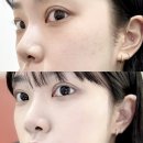 [공지] 강서구 가양동 피부과 한의원에서 거우침 시술로 편평사마귀 치료받은 솔직 후기