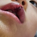 글로벌서울성형외과의원 | 유아 응급 봉합수술 가능한 병원 &#34;서초서울마더스성형외과 후기&#34;