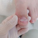 네일,꽃이피다&레푸스(명일점) | 레푸스 내성발톱 교정 비용, 과정, 관리 후기 (발바닥 각질 관리까지)