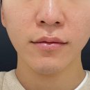 포톤테라피