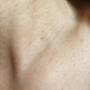 율무 | 비교사진있음! 편평사마귀 율무 홈케어, 면역반응 후기 4탄