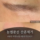 착한눈썹 | [착한눈썹]_눈썹 잔흔제거 후기_동탄눈썹잔흔제거_눈썹잔흔제거