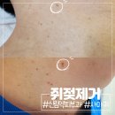 신림당약국 | 신림 역이랑 가까운 피부과 사마귀 쥐젖제거 후기