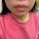 아로움헤어 | 마곡 희아로움 문제성 피부 강서구 여드름 관리 잘하는 곳 압출 최고