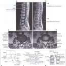 MRI 보는법 1.- Lumbar Spine 이미지
