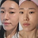 일산 백석동 에스테틱 쉬작에서 안면홍조관리 물방울초음파 받았어요~