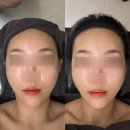 양덕동202 | 마산 양덕동 윤곽관리_온본에스테틱 / 본페이스 V핏 관리로 이중턱 리프팅 받은 솔직후기