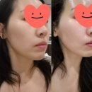 의성한방병원 | 관리 추천, 땅콩형 얼굴 &amp; 얼굴 비대칭 고민 한번에 해결하고 온 후기! - 도봉구청 근처 바디디자인뷰티