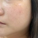 파주피부관리 색소침착에 효과적인 플라즈마관리 운정 라온에스테틱에서 받았어요