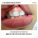 4살 아이 앞니 검은 얼룩 원인? 철분 치아 착색｜송도 어린이치과 검진 후기