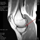 연골손상으로인한 무릎통증.관절내시경 수술 이미지