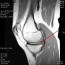 무릎관절 통증 무릎연골파열 주의해야 이미지