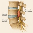 허리디스크(요추 추간판 탈출증) 원인·증상·진단·치료 총정리 이미지