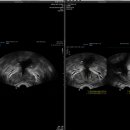 강서비뇨기과의원 | 프로게이터 후기, 유로리프트 대신 선택한 55세 남성 사례