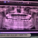 삼창치과의원 | 쌍용동 열린치과 사랑니발치후기