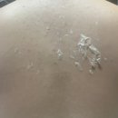 강남 등드름 여드름흉터 알라딘필링전문 라엘보떼(시술과정, 통증, 탈각, 2회차 찐후기)