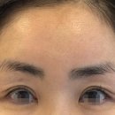 연세이앤비성형외과의원 | 연세이앤비 중년층 눈 성형 망설이는 이유는?