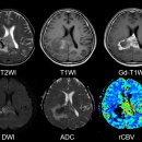 악성 뇌교종[malignant glioma] 이미지