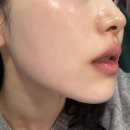 하얀멍이 | 부산 서면 스킨부스터 1회차 내돈내산 후기! | 셀르디엠 통증, 마취, 회복기간, 당일붓기 멍