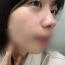 [앰플추천] 수아록 기미앰플 2주 사용 후기✨ | 순수비타민C앰플로 피부톤 관리 시작!