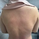 강남-152 | 강남피부관리 등 트러블 강필 받고온 후기 l 더록시에스테틱청담점