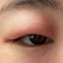 에이디솔루션 | 30일 후기!에이디솔루션 크림 건조,아토피 습진피부 크림 후기들고왔습니다