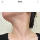 블리스의원 | [반포동피부과/블리스의원] 목주름필러후기