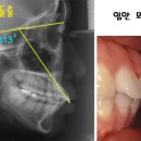 잇몸돌출과 치아돌출의 차이 이미지