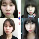 쌍커풀수술후기 정보 알려드립니다~