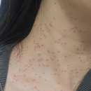 참편한가정의학과의원 | 이삭가정의학과 - 편평사마귀 성지 후기 (+ 처방/재생크림 꿀팁)