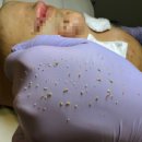 6 | 오산 여드름, 저주받은 피부 6회차 만에 기적같은 후기