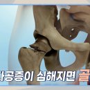 중년 여성 건강의 적신호 골다공증! 이미지