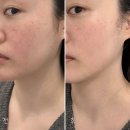 썬메디칼 | 대구 피부관리, 눈밑꺼짐 볼꺼짐 셀룩스프로 1회차 후기