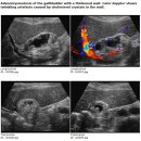 Adenomyomatosis GB 이미지