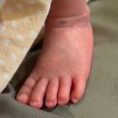 메디팜나은약국 | 종로 에스앤유피부과 - 이소성 몽고반점, 선천성 모반 치료 1~5회차 후기