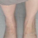 [병점/영통] 발목인대전체파열 튼튼병원_Xray,초음파,MRI촬영 후기