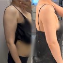 365행복케어 | [결혼 준비] 일산 365 팔뚝 무한람스 시술 2주차 3주차 후기 (후관리 리포덤 중저주파 레이저)