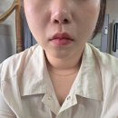 에이블러의원 | 김해에이블러의원 쿨소닉 12000샷 + 쿨페이즈 600샷 리얼 후기 통증 없는 쫀쫀 리프팅 신세계