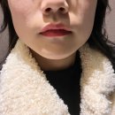 탑성형외과의원 | 동성로리프팅 | 팔자라인 턱라인 슈링크400샷 리얼후기