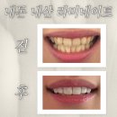 이로울치과 | ※내돈내산※ 오브치과 라미네이트 오브제로...라미네이트, 오브제로, 후기, 장단점, 치아성형, 잇몸...