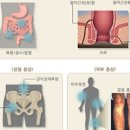 크론병 증세 원인 진단 낫는법 이미지