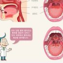 편도 부었을때 약 아이스크림 음식 편도가 아파요 이미지