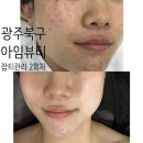 신안동2 | 광주 북구 신안동 색소관리 아임뷰티 2회차 대만족 후기