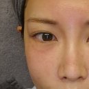 고우리 | 신사동피부과 고우리부스터 후기 콜라겐 스킨부스터 효과